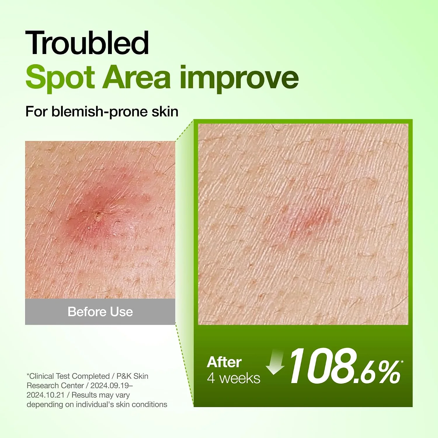 Anua Azelaic Acid 10 Hyaluron Redness Soothing Serum (30mL)