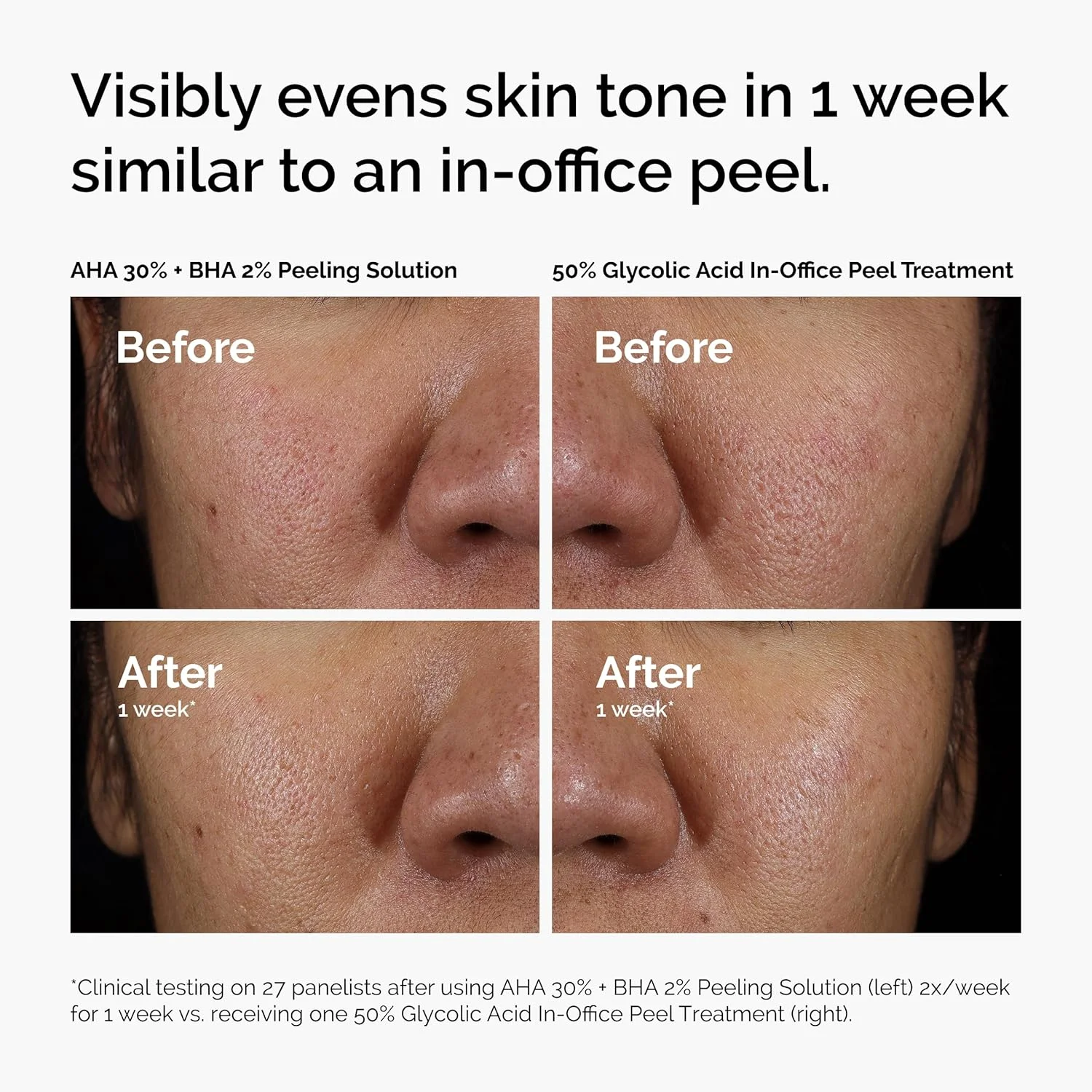 The Ordinary AHA 30% + BHA 2% Peeling Solution Serum (30mL)